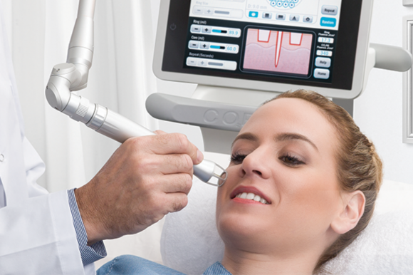 Well Resurfacing Laser Well Resurfacing Laser